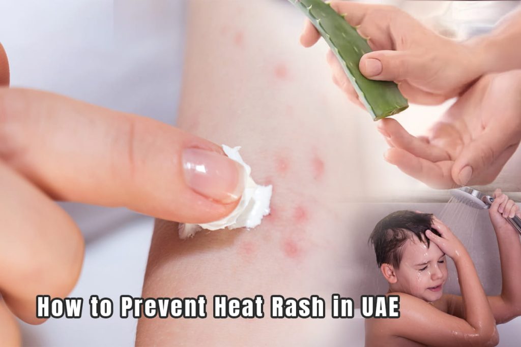 Understanding Heat Rash