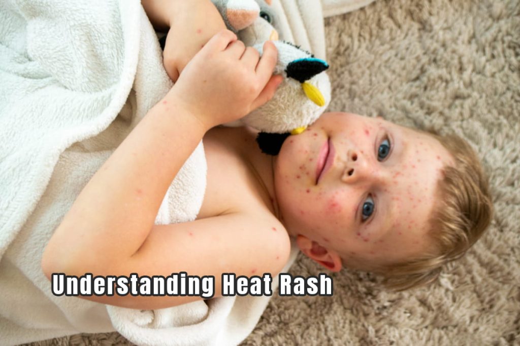 Understanding Heat Rash